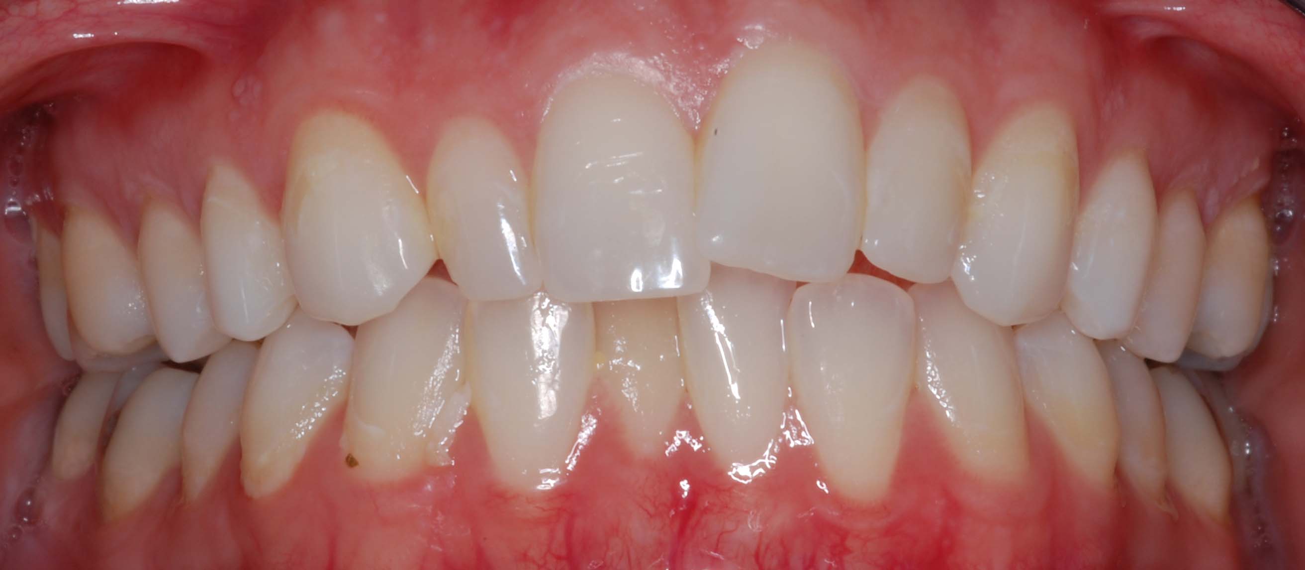 Invisalign Before